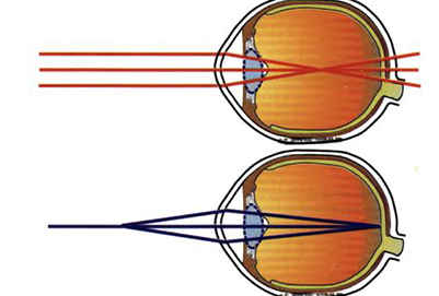 近视眼
